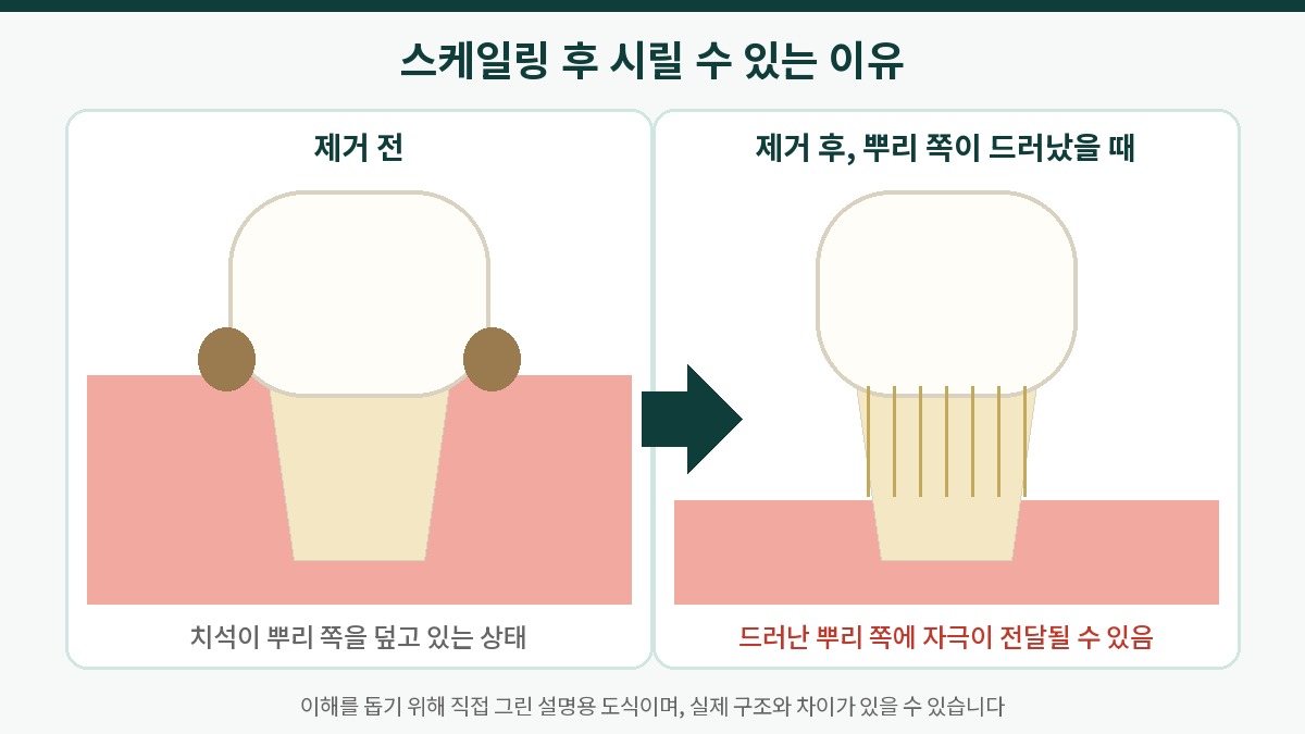 치석 제거 전후 치아 뿌리 쪽 노출 변화를 비교한 설명용 도식